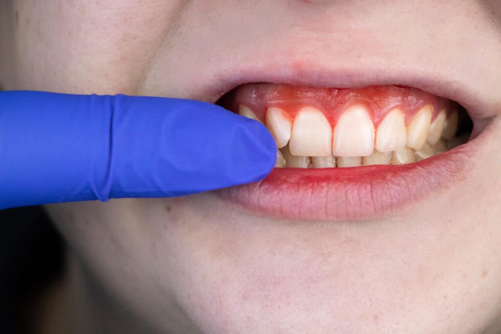 Fighting Gum Disease with LANAP Laser Therapy