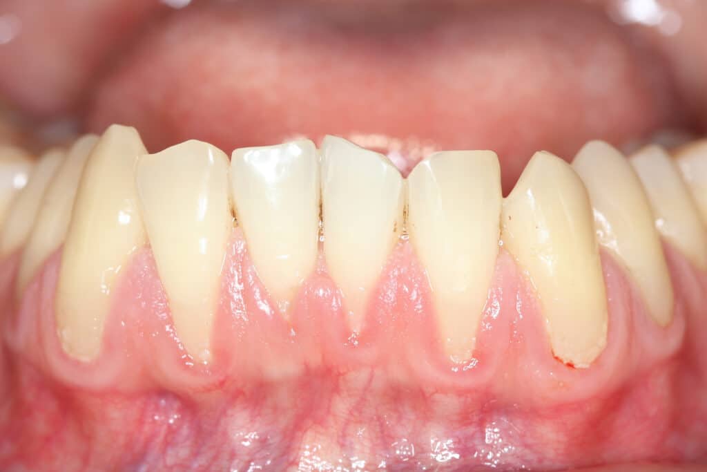 Gingival Recession