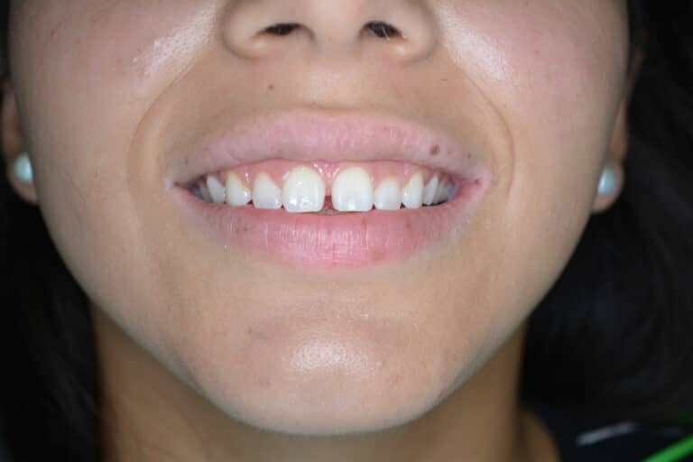 Gingivectomy Near Me Gingivectomy Before and After