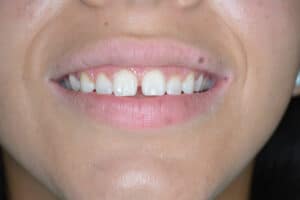 Gingivectomy Near Me | Gingivectomy Before and After